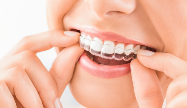 Wine Street Dental blog-inner